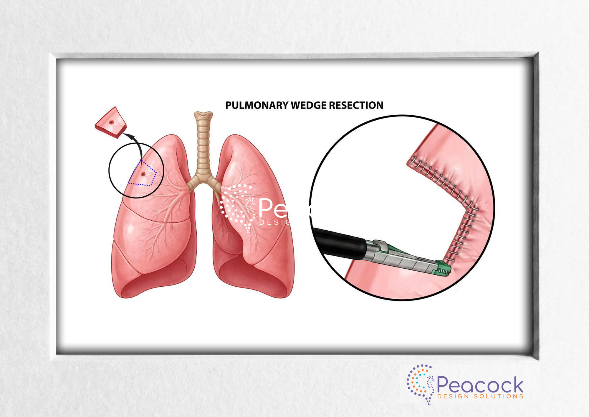 Pulmonary Wedge Resection