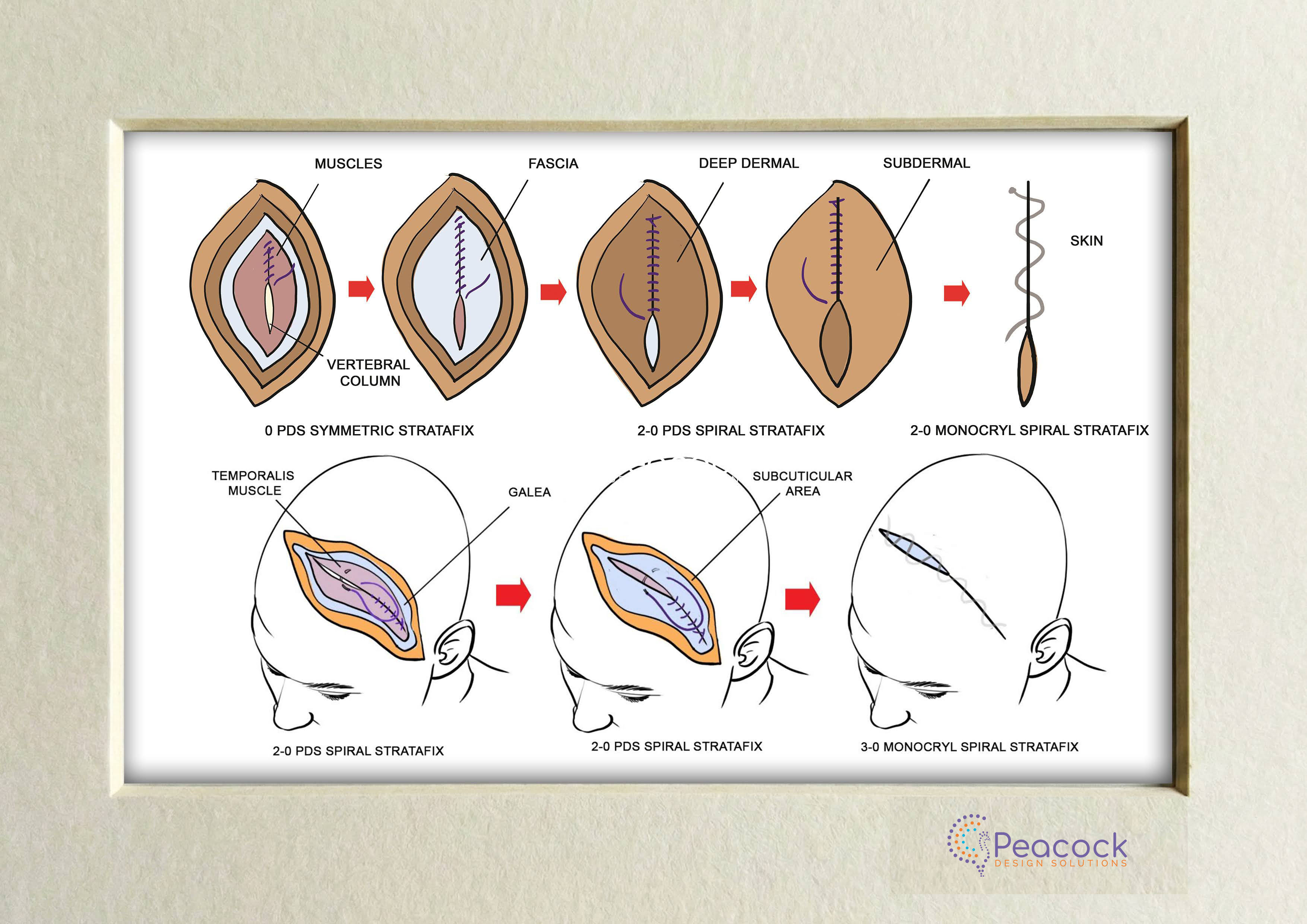 Wound Closure Techniques
