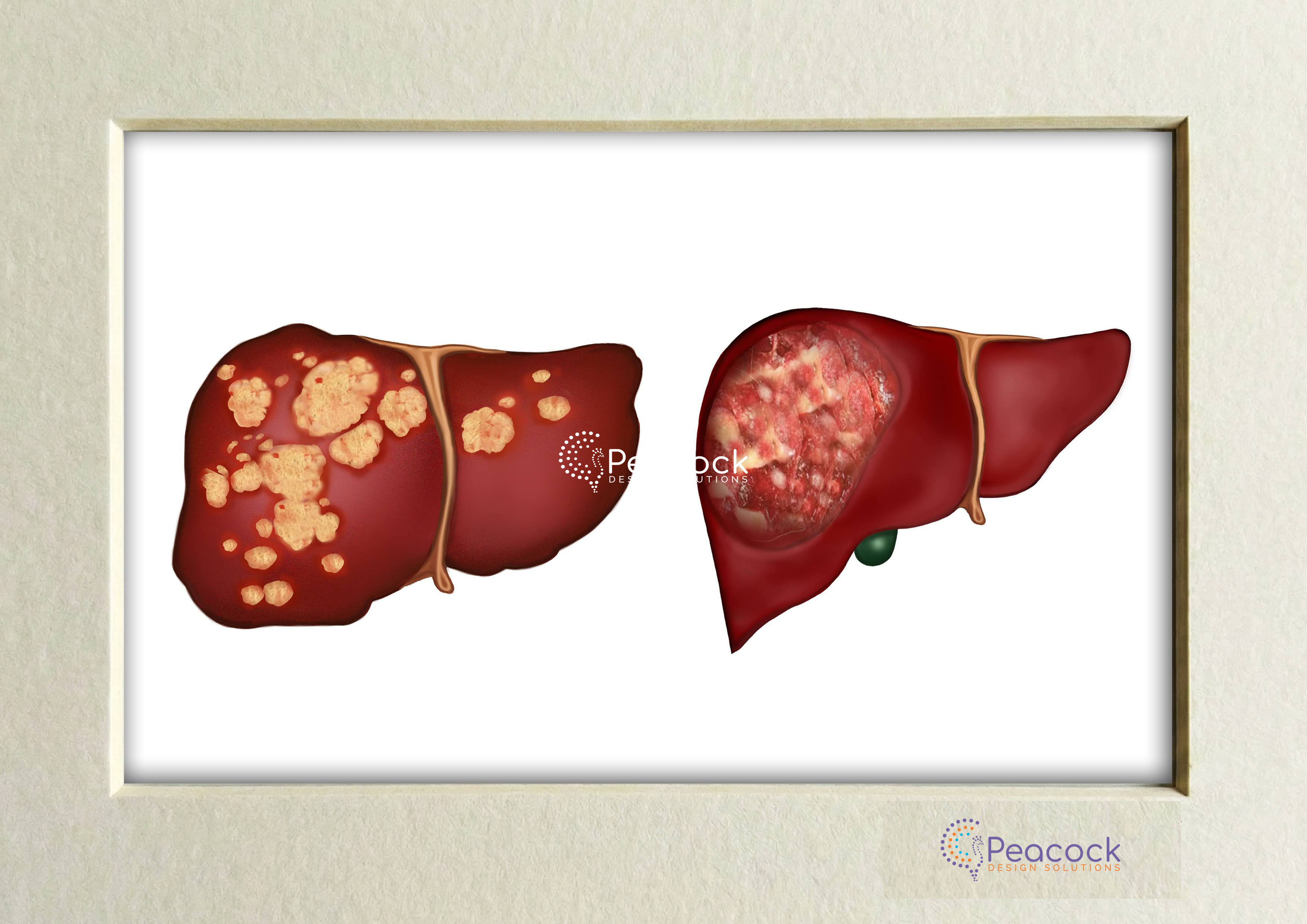 Liver Disease Pathology