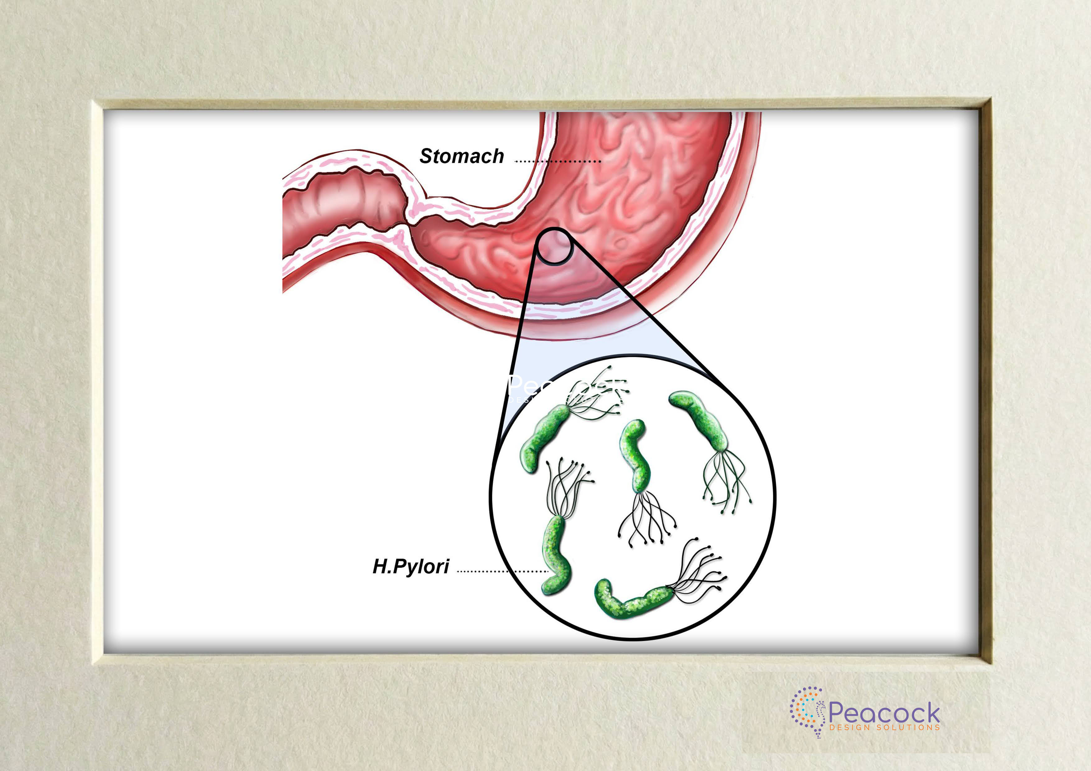 H. Pylori Stomach