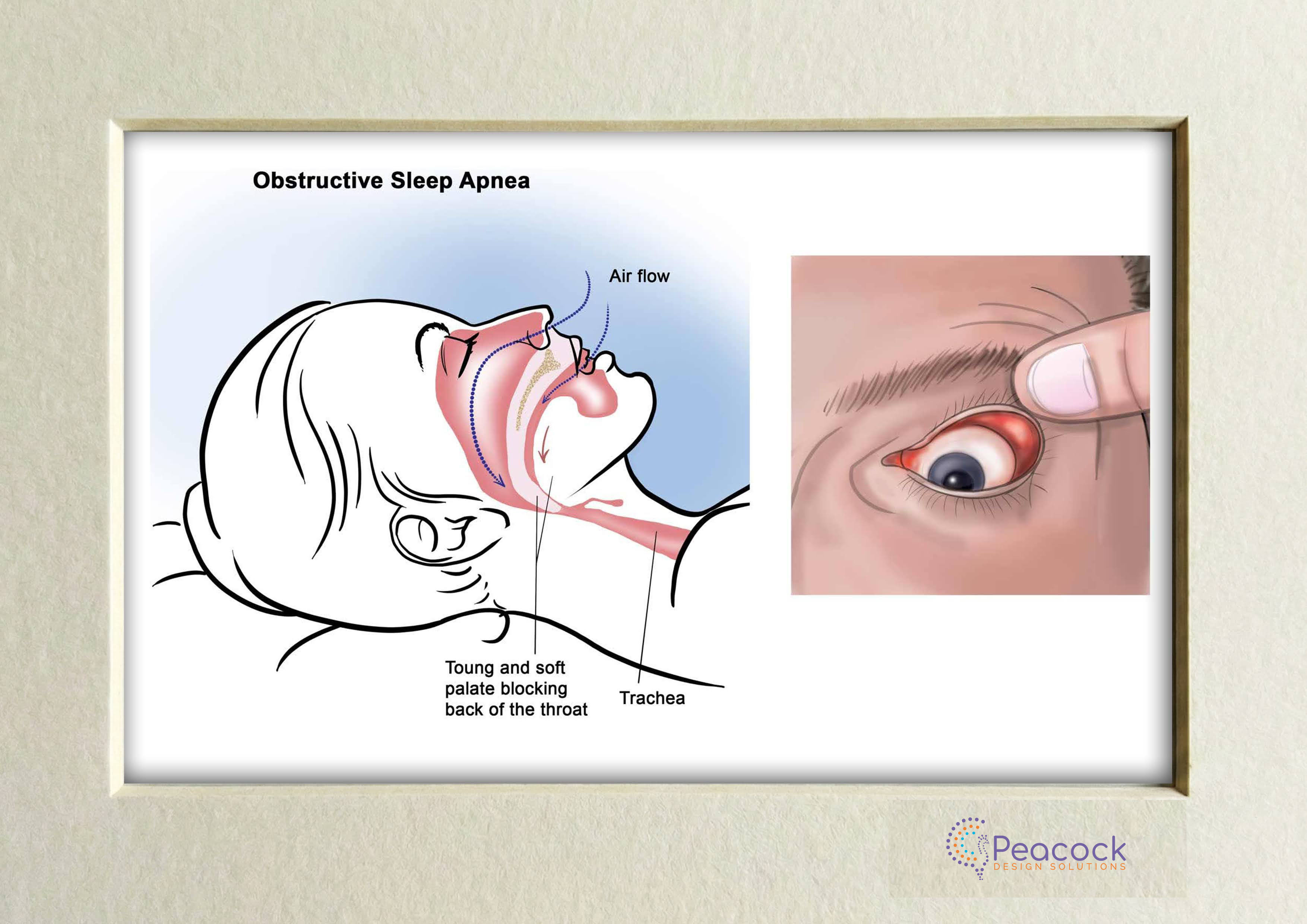 Obstructive Sleep Apnea