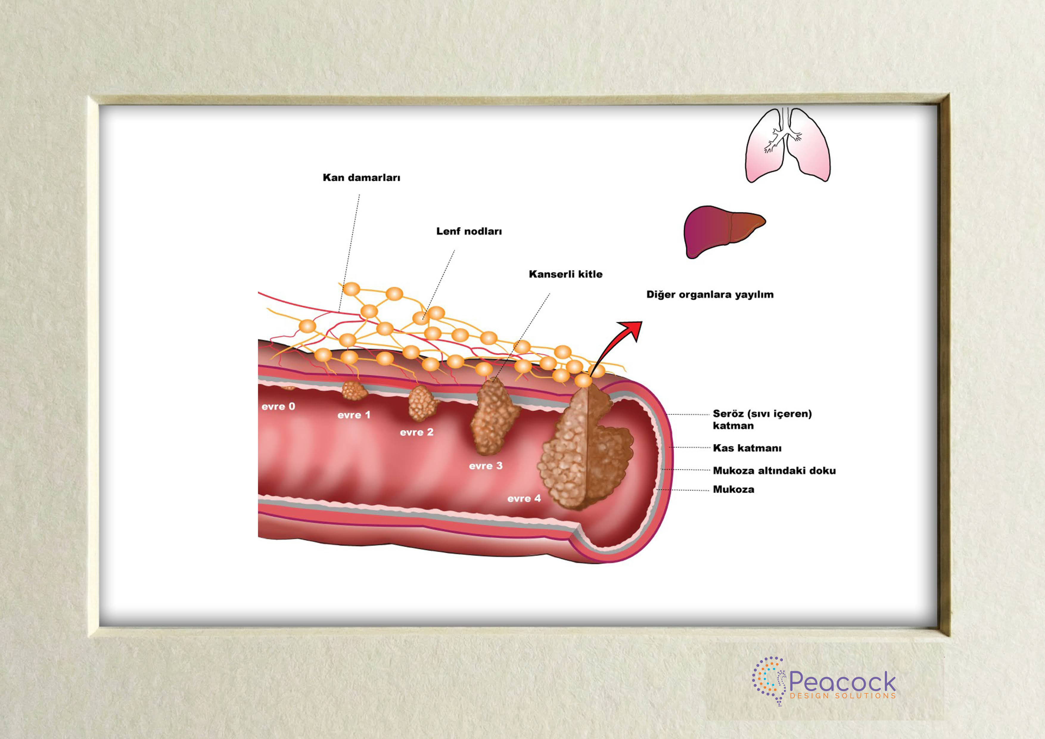 Colorectal Cancer Staging